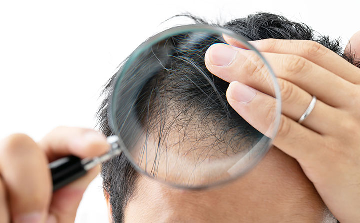 薄毛治療（オーダーメイド処方）