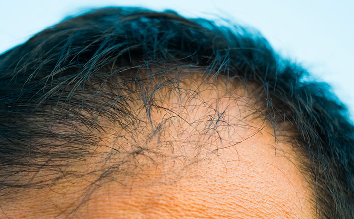 薄毛治療（オーダーメイド処方）