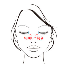 目頭切開