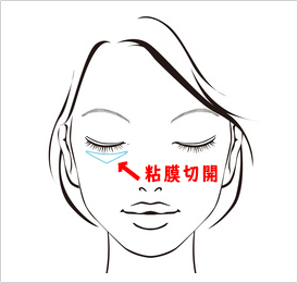 下眼瞼脱脂