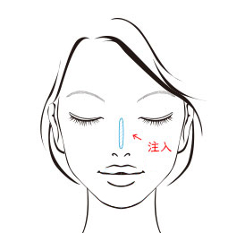 隆鼻術・整鼻術（注入治療）